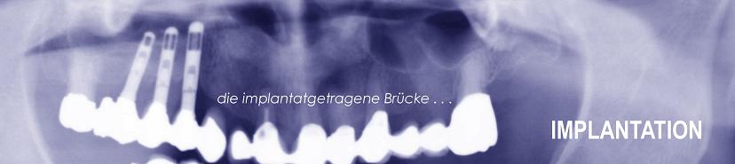 Implantatgetragene Brücke